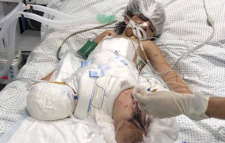 تخوض الطفلة الفلسطينية وفاء حمد صراعًا من أجل البقاء في مستشفى كمال عدوان شمال قطاع غزة، بعد أن فقدت كامل أفراد عائلتها في هجوم شنه الجيش الإسرائيلي على منزلهم.وأدى الهجوم إلى بتر ساقها اليمنى، وفقدانها لبصرها بالكامل، إلى جانب إصابتها بحروق وجروح عميقة في وجهها ومعظم أنحاء جسدها. ورغم الإمكانات المحدودة، تتلقى وفاء الرعاية الطبية المتاحة وسط ظروف إنسانية قاسية.