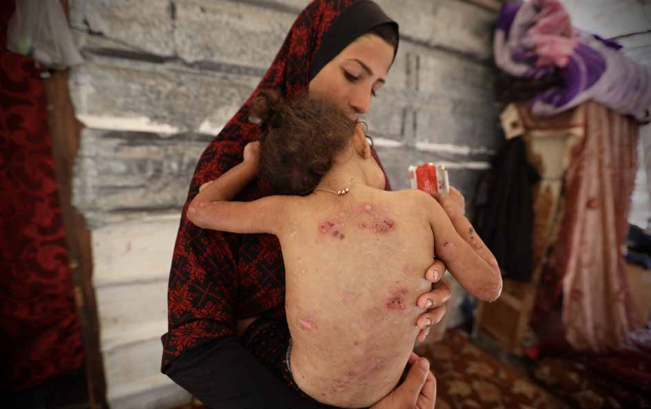 Forced to flee her birthplace in Gaza City’s Shuja’iyya neighborhood due to Israeli attacks, 2.5-year-old Sunduz Fadi al-Daalis now struggles to survive with her family in a tent in the Zaytoun area. Diagnosed with pemphigus foliaceus, a rare autoimmune skin disease, Sunduz’s condition has worsened due to hunger, malnutrition, and the lack of medical care. Explosive residue and the unhealthy conditions of tent life continue to aggravate her illness. Her family is urgently appealing for medical assistance to save her.
