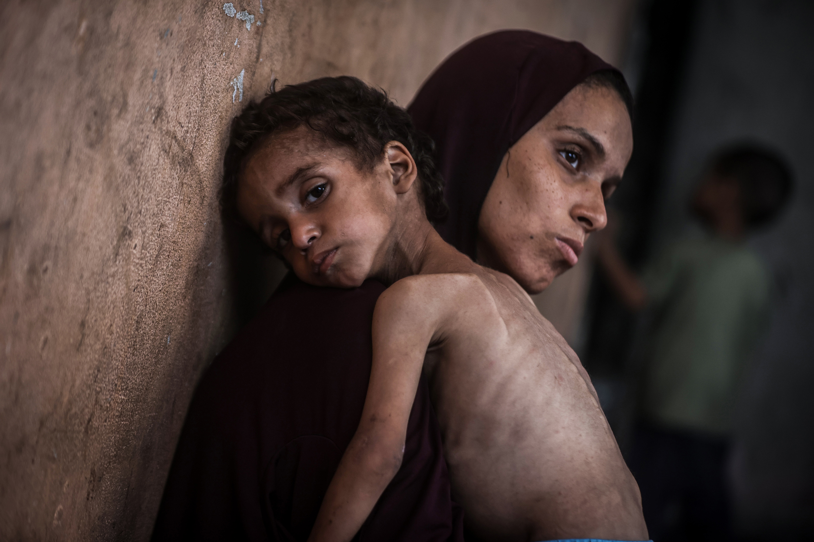 2-year-old Palestinian Yezen Abu Ful, whose health has deteriorated due to lack of access to food and nutritional supplements, is seen with his mother in the Al-Shati Refugee Camp in Gaza Strip on July 24, 2025. Food shortages caused by Israeli attacks and the deepening humanitarian crisis are threatening the life of 2-year-old Yezen Abu Ful. Living under harsh conditions in the Al-Shati Refugee Camp in western Gaza City, the Abu Ful family has issued a plea for help for their struggling child.